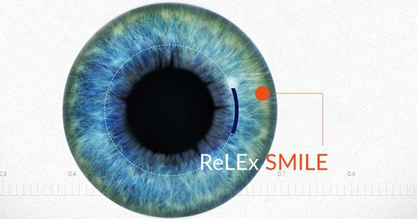 Phương pháp phẫu thuật ReLEx SMILE chữa tật khúc xạ tiên tiến nhất hiện nay